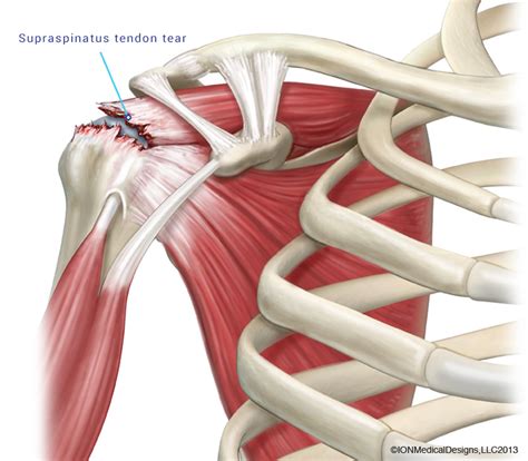 Using Size of a Rotator Cuff Tear to Determine Surgery